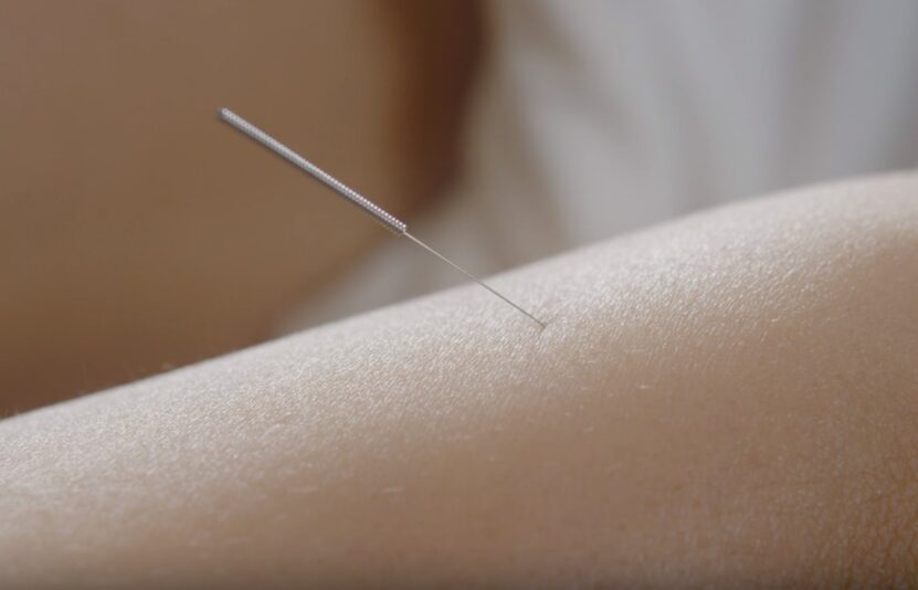 acupuncture